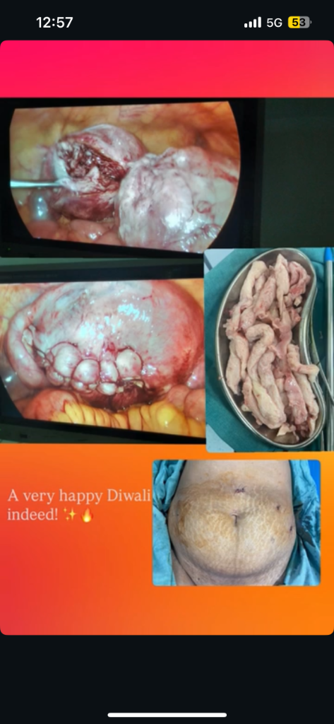 Surgical Outcome: Restored uterus and minimal keyhole scars